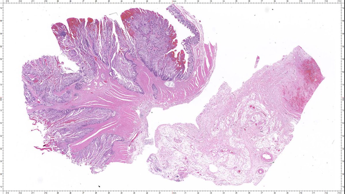 Vik_deshpandeMD's tweet image. Here's an invasive tumor of the colon that I found this morning!  This case is older than the majority of you - by a couple of decades! this one is special!! #GIpath