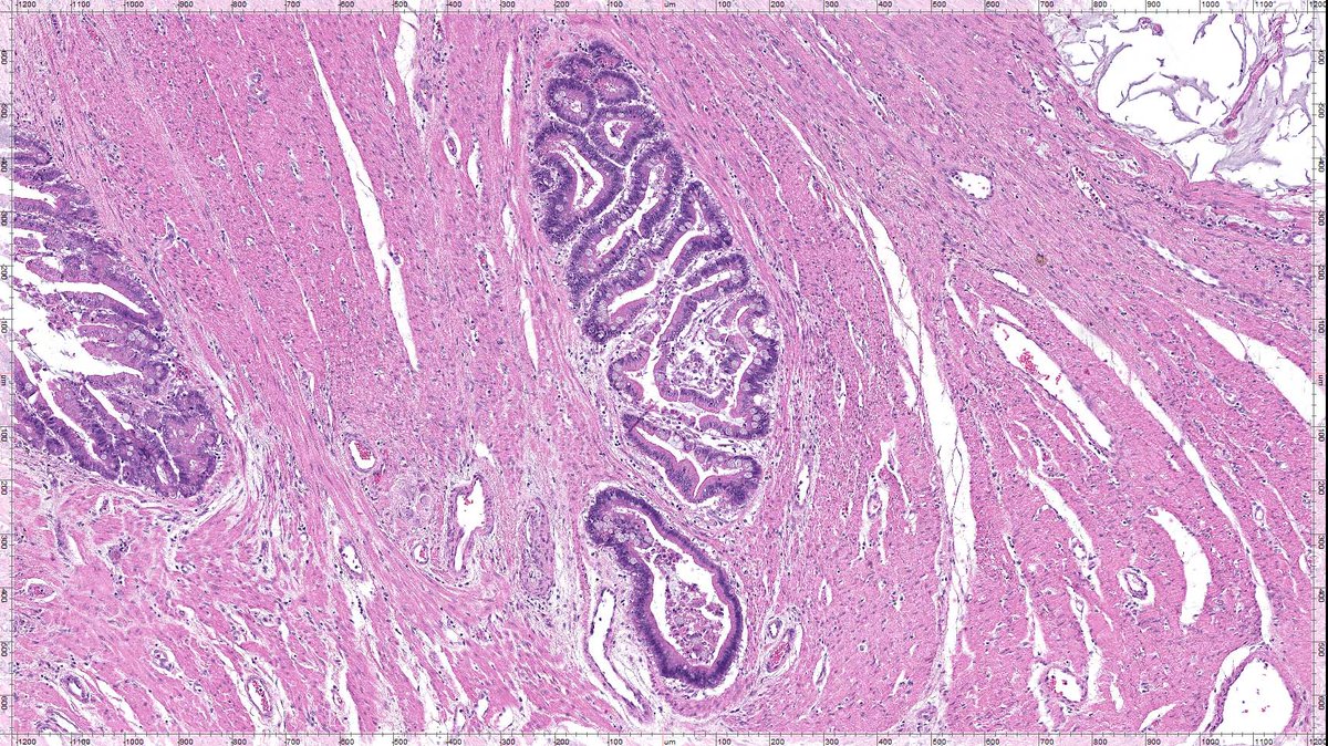 Vik_deshpandeMD's tweet image. Here's an invasive tumor of the colon that I found this morning!  This case is older than the majority of you - by a couple of decades! this one is special!! #GIpath