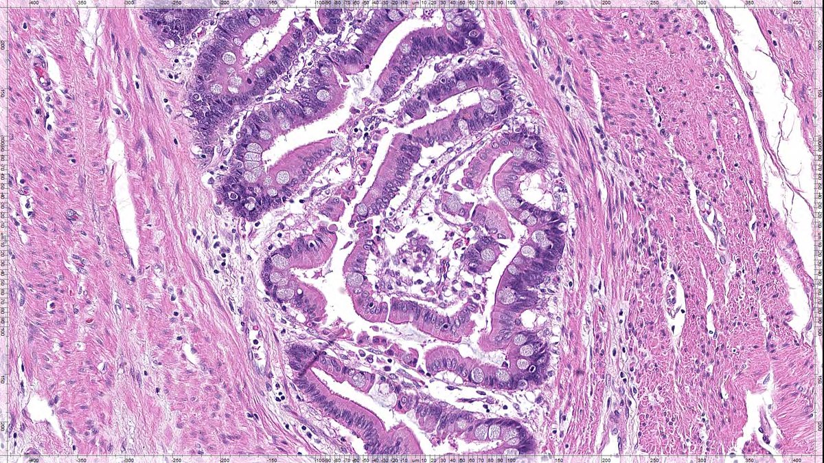 Vik_deshpandeMD's tweet image. Here's an invasive tumor of the colon that I found this morning!  This case is older than the majority of you - by a couple of decades! this one is special!! #GIpath