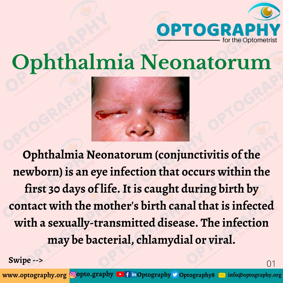Ophthalmia Neonatorum