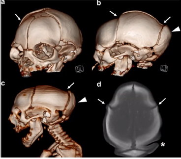 Congenital Zika: Fetal brain disruption sequence-- posterior skull formation ceases and forms ridge <a href="/VirusDocDeBiasi/">Roberta DeBiasi</a> #VailPedsID2021