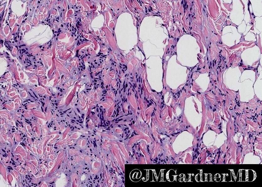 JMGardnerMD's tweet photo. One classic pic. No history. Can you make the diagnosis? Answer &amp; more info here: https://t.co/fqaT8YsPqc. #pathology #pathologists #pathTwitter #dermpath #dermatology #dermatologia #dermtwitter #bstpath https://t.co/PhvwE0zSdu