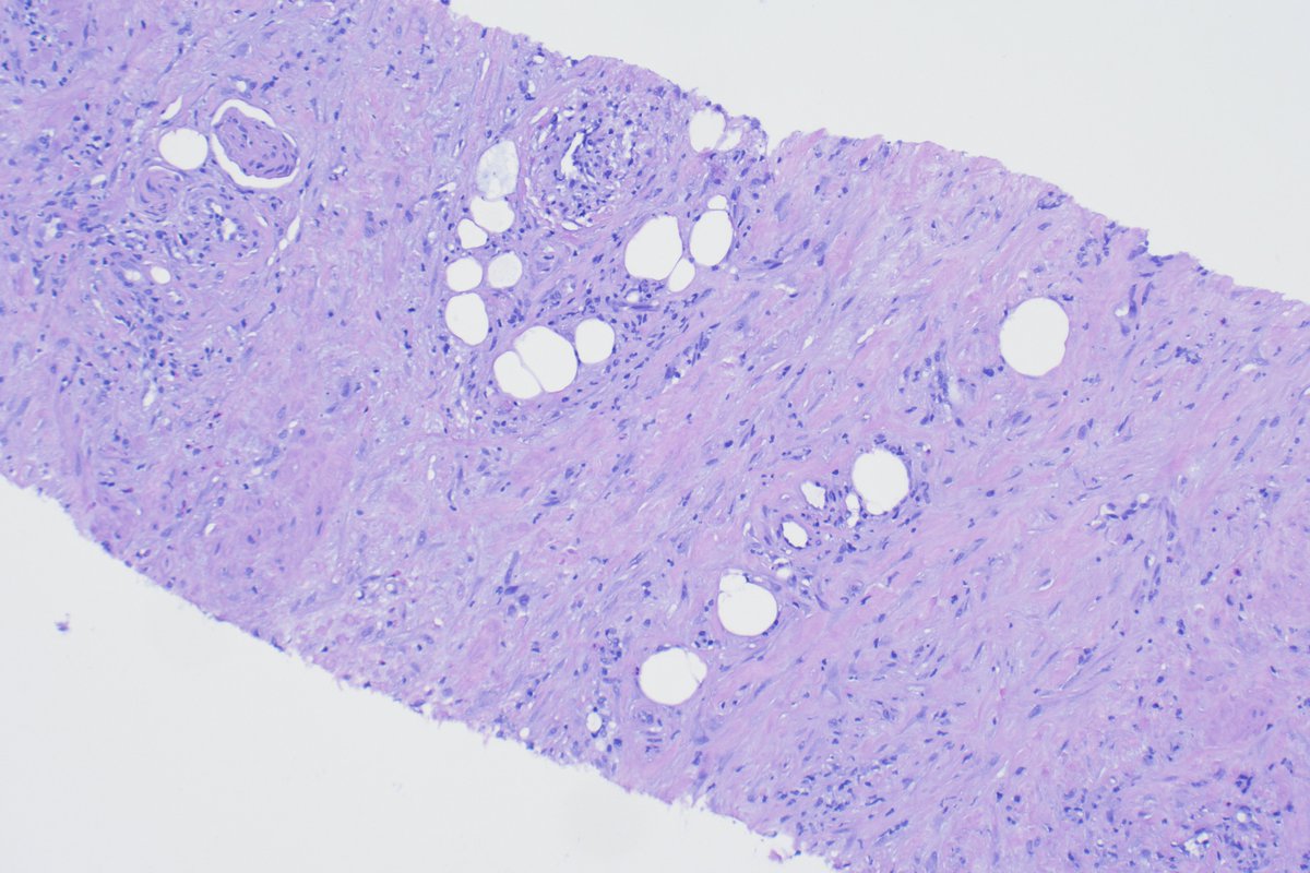 #prostatebiopsy # Summerquizz week 3 day 12, how would you call this? Would you do some IHC and if yes which? (Only 1 choice) #Gupath