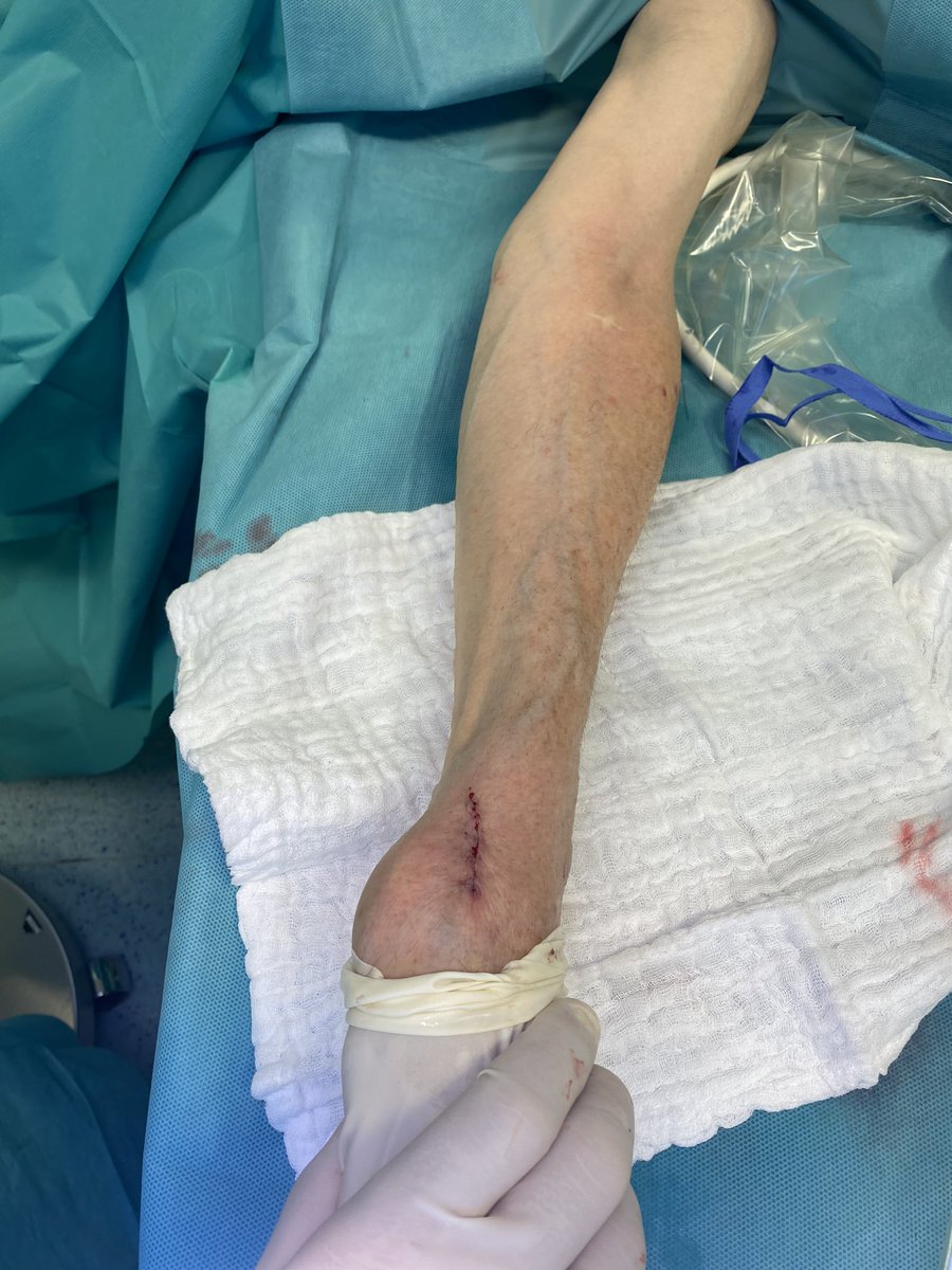 robshahverdyan's tweet photo. When you patient‘s veins look like that BEFORE you create an #AVF then it’s not much left to do except to „dive into the“ #snuffbox #Tabatiere #VascularAccessCenter #Hamburg #CKD #ESRD #AxillaryBlock #RegionalAnesthesia https://t.co/IJLDPkSV3s