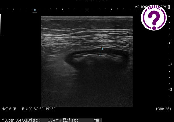 Case of the Month August – Clinical picture vs imaging findings: an ultrasound surprise.
View the case, images and question here >> wfumb.info/2021/08/05/aug…