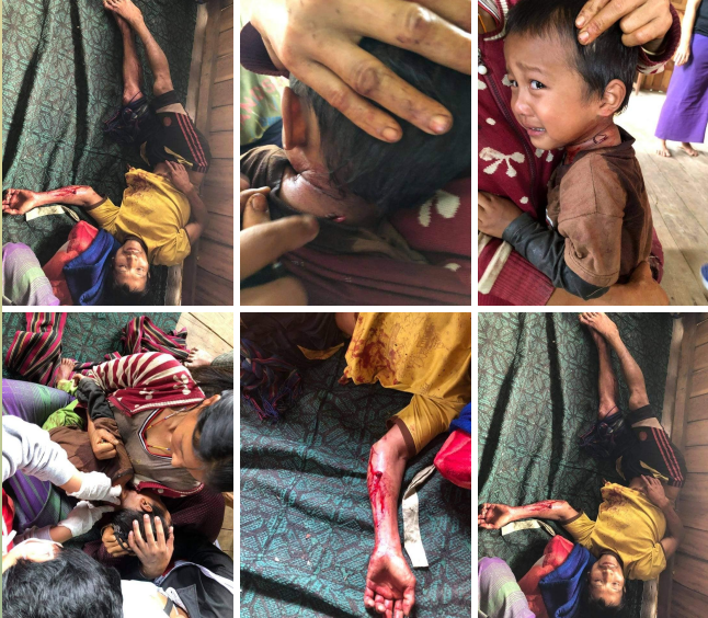 spring21MM's tweet photo. Tw\\blood,wounds
Due to Military Terrorist troops randomly FIRED heavy weapons for no apparent reason in #Kantaryone village,#Kanpetlet Tsp this morning(Aug 15),

-A 2 yrs old child &amp; his 30 yrs old father were seriously INJURED in the abdomen, arms &amp; legs and...(1/2)

#Aug15Coup https://t.co/O2UHYVVfqd