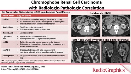 Chromophobe Renal Cell Carcinoma with Radiologic-Pathologic Correlation | RadioGraphics pubs.rsna.org/doi/10.1148/rg…
