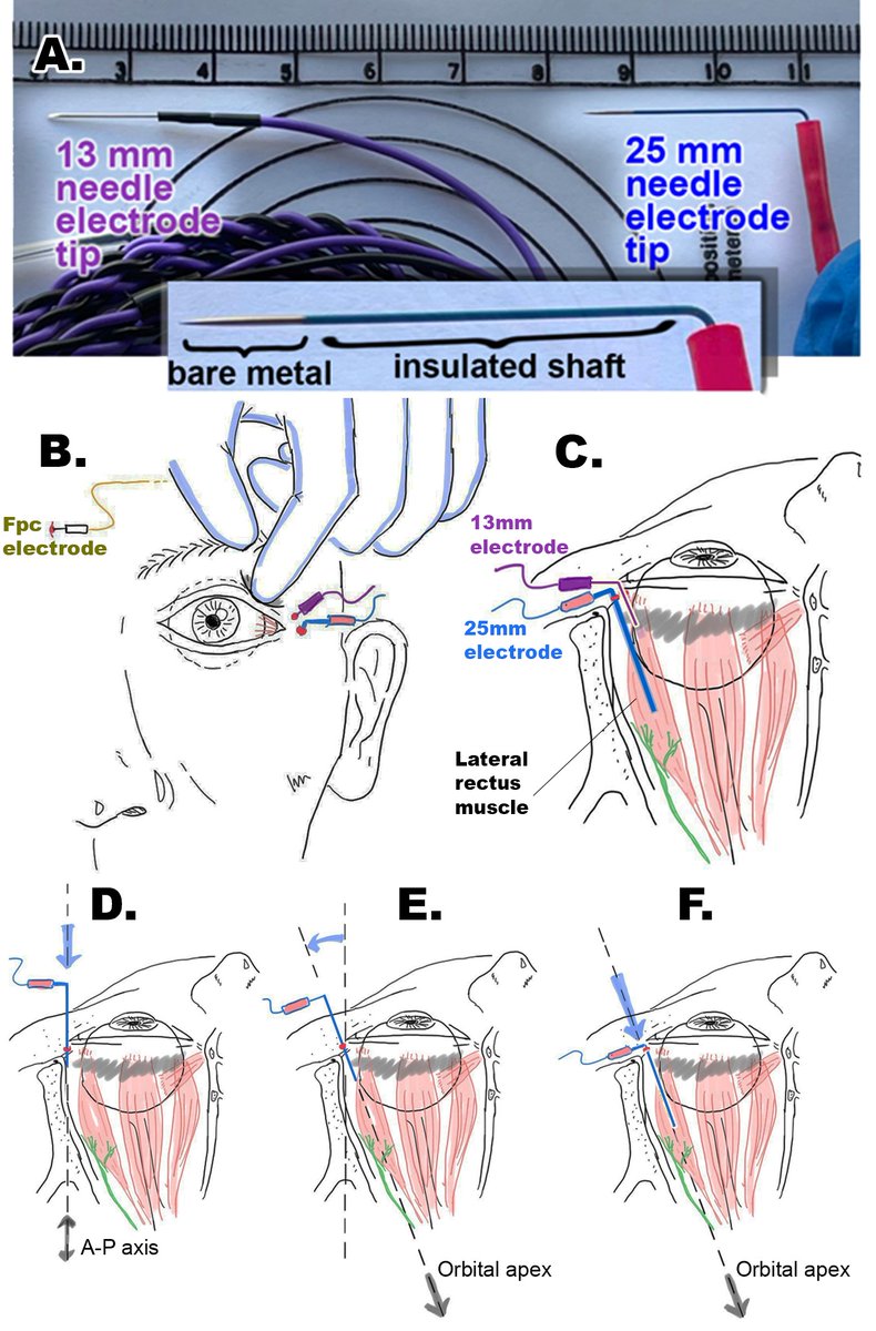 ClinicalNeuroph's tweet photo. [Intraoperative neuromonitoring] Oishi et al.: "Intramuscular recordings from long electrode in the lateral rectus offers more reliable EMG monitoring than 13 mm needles, with excellent discrimination between abducens and facial nerve stimulations."

https://t.co/VnQ2T7Zy4Q https://t.co/fXcypdZHD9
