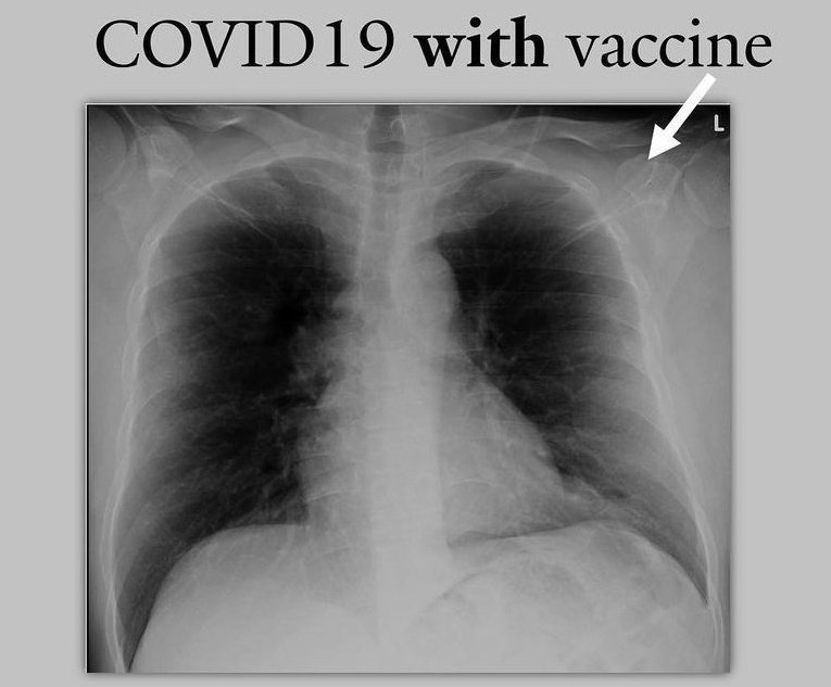 faria_manuel's tweet photo. Hombre de 47 años que recibió la vacuna Pfizer y desarrolló COVID19 2 semanas después. Tenía sobrepeso (IMC=29), pero sin comorbilidades conocidas. Tuvo secreción nasal, dolor leve en el cuerpo, tos leve. Su radiografía de tórax es relativamente normal.
#15agosto #Covid #UniVe https://t.co/DKZ2YwbeSb