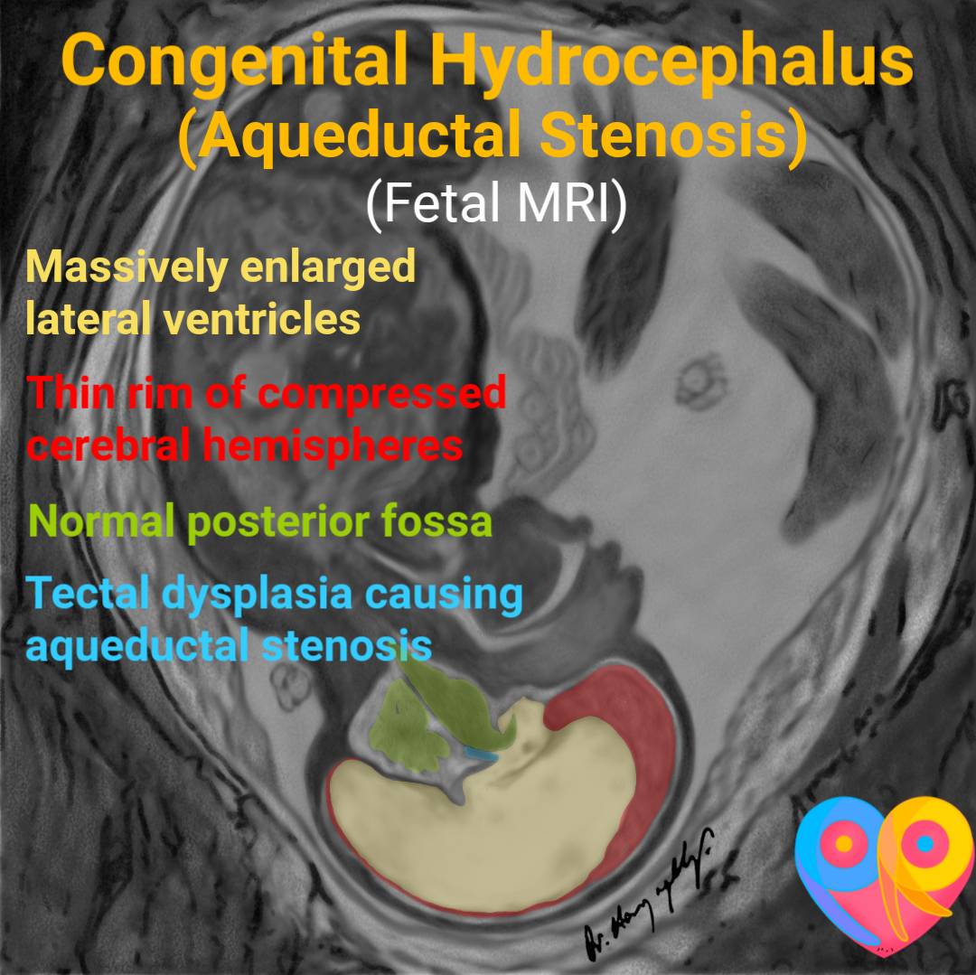 Congenital Hydrocephalus Causes