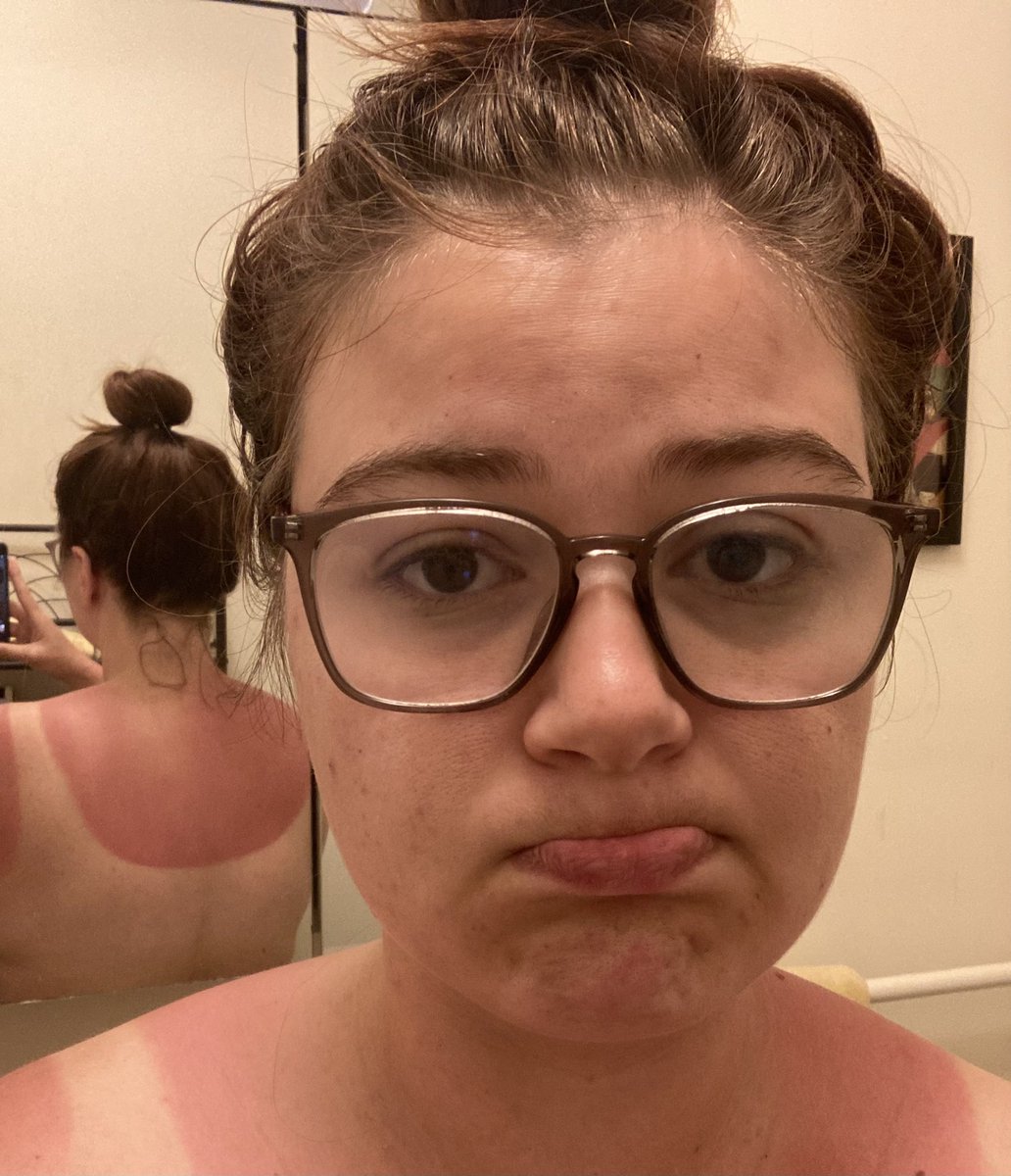 Brunch is now a full contact sport.

Wear your sunscreen, people. Even if you don’t think you need it. Even if a magical dolphin told you…

Currently using cold cloths, aloe lotion, ibuprofen—now seeking all additional un-ouching advice. Wrong answers welcome and encouraged.