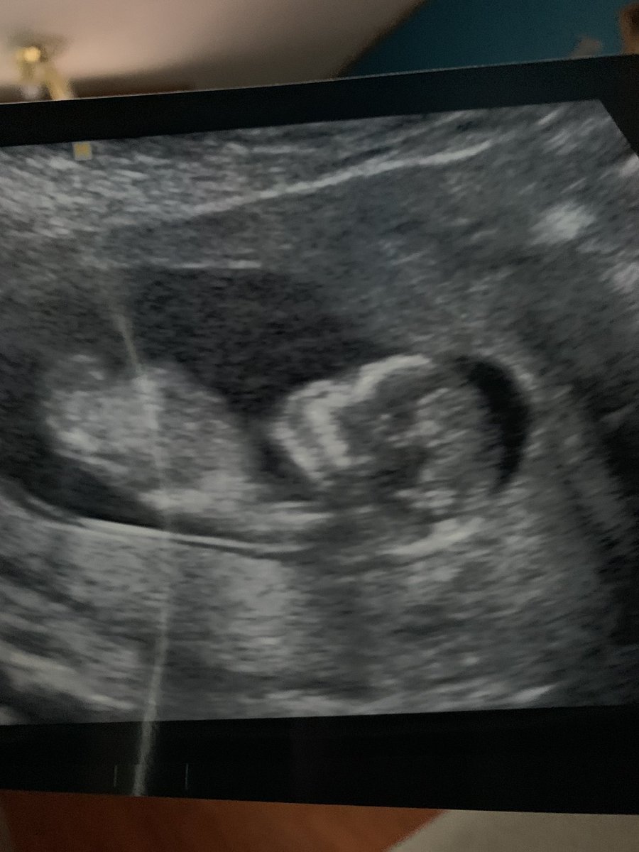 EricaMarie96's tweet photo. We are so ready for you baby boy π #babyjunebug #Valentinesdaybaby https://t.co/gmuknSz1jq