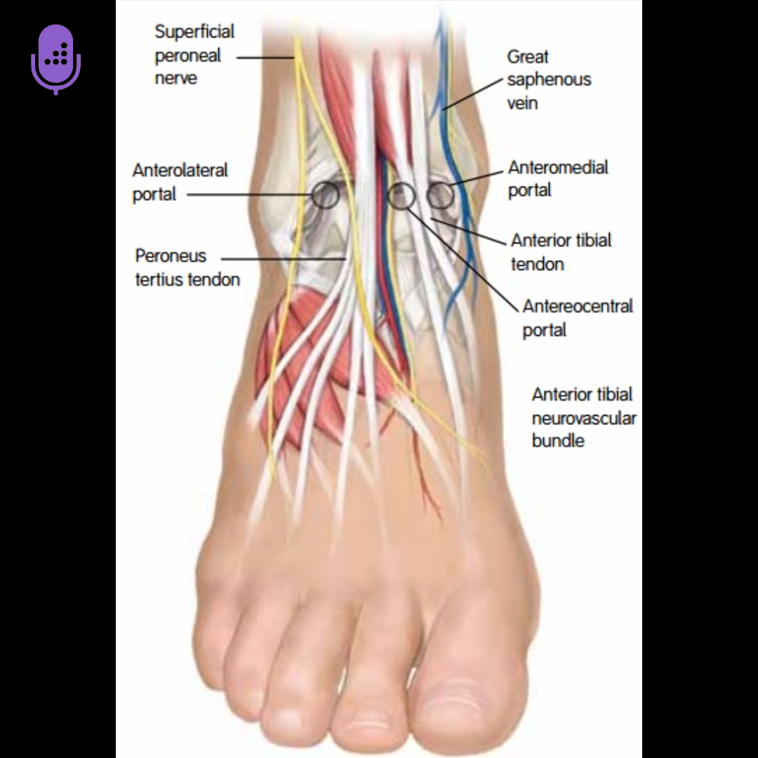 orthobullets's tweet image. The superficial peroneal nerve (SPN) is the most common nerve injured during ankle arthroscopy and is associated with anterolateral portal placement.

Learn more on the Medbullets DAILY Step 2 &amp;amp; 3 podcast. #usmle #medschool #medstudenttwitter  orthobullets.tiny.us/4dwj5st8