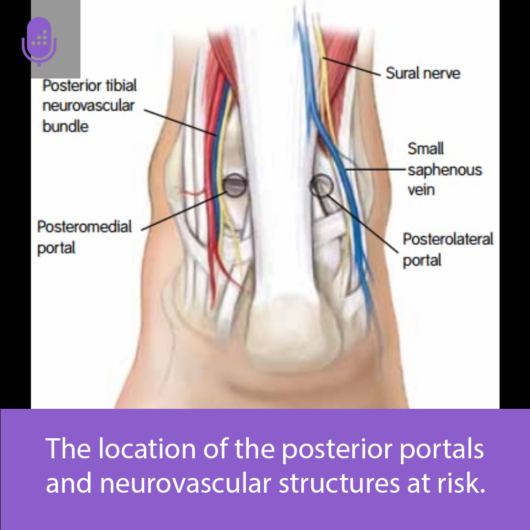 orthobullets's tweet image. The superficial peroneal nerve (SPN) is the most common nerve injured during ankle arthroscopy and is associated with anterolateral portal placement.

Learn more on the Medbullets DAILY Step 2 &amp;amp; 3 podcast. #usmle #medschool #medstudenttwitter  orthobullets.tiny.us/4dwj5st8