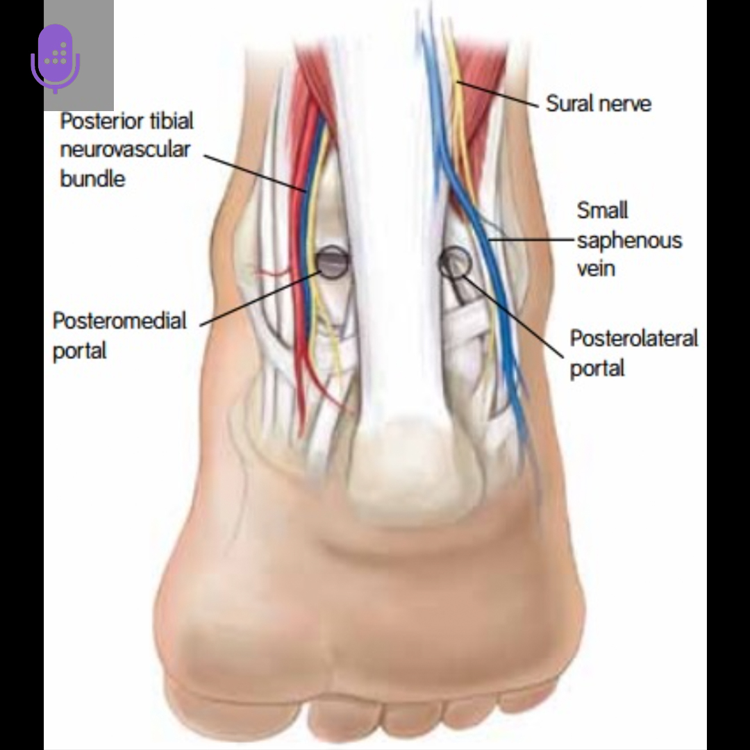 orthobullets's tweet image. The superficial peroneal nerve (SPN) is the most common nerve injured during ankle arthroscopy and is associated with anterolateral portal placement.

Learn more on the Medbullets DAILY Step 2 &amp;amp; 3 podcast. #usmle #medschool #medstudenttwitter  orthobullets.tiny.us/4dwj5st8