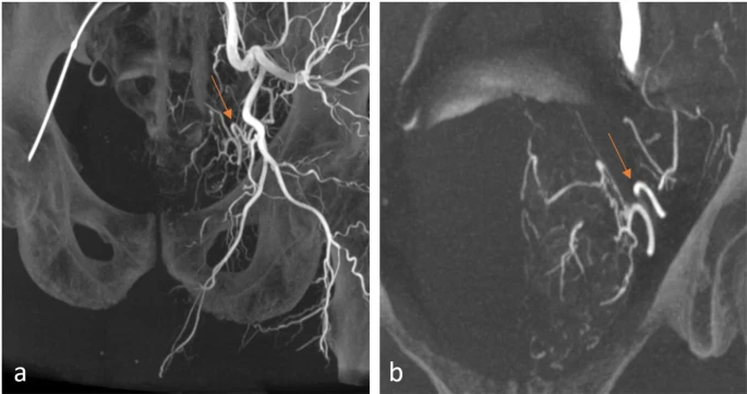cvirendo's tweet photo. Read the most recently published article on advanced image guidance for #prostaticarteryembolization β a multicenter technical note: https://t.co/e5dbS51vmj #irad #PAE #openaccess
@TimMcClureMD @IR_Nutt https://t.co/WZsDejcDAR