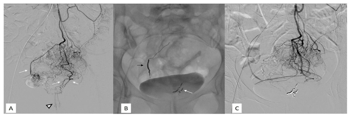 #mdpijcm
New #Review “Hemorrhoids Embolization: State of the Art and Future Directions” by Alberto Rebonato et al.
More info at mdpi.com/2077-0383/10/1…
#hemorrhoids #embolization #interventionalradiology #bleeding #coilembolization
