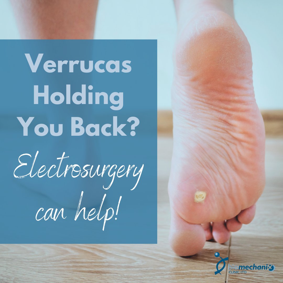 Electrosurgery could help with your verrucas or skin lesions.

Electrosurgery takes about 1 hour to complete, and in 1-3 days you will need to have your dressing changed.

Usually healing takes 10-14 days, depending on how much rest you can take.

Book via biomechanix.co.uk