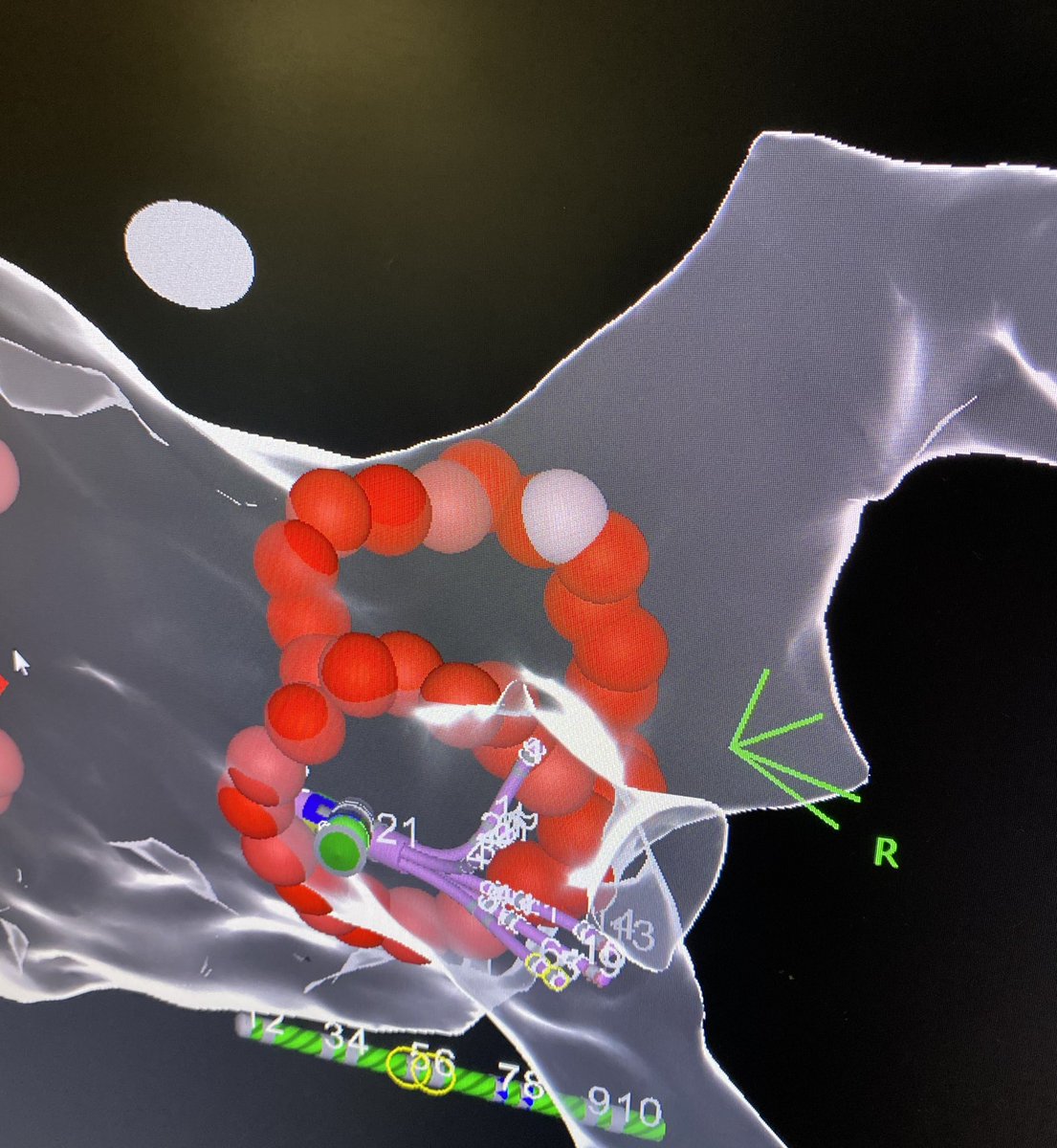 #EPeeps sometimes need an “8” to isolate #PVI #AF #AFablation #ablation