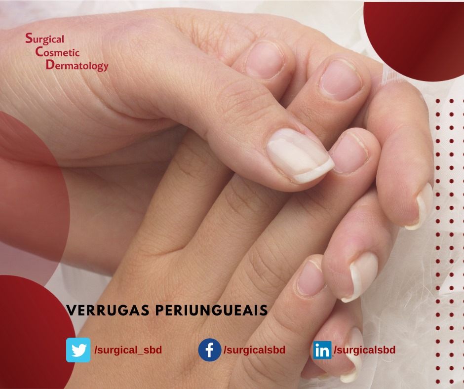 surgical_sbd's tweet photo. Verrugas são os #tumores periungueais mais frequentes nas consultas dermatológicas. São causadas por diversos tipos de papilomavírus humano (#hpv), e parte destas lesões evolui com cura espontânea.

Saiba mais:
https://t.co/bOXG1BQnOg https://t.co/CIJ8JOf2ty