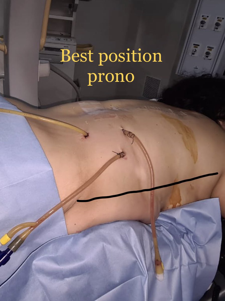 Choosing the best calix and the best position!! Some times the calix is parallel to spin and is inaccesible to Valdivia position. If you don’t have flexible instruments you have to do more than two tracts.