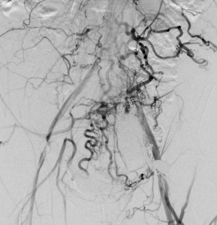 Sasha Ushinsky (@sushinsk) on Twitter photo Post-traumatic AVM with prior occlusion of the left IIA and stent-grafting of right CIA-EIA. Anigogram, venogram and finally percutaneous puncture into the outflow with glue and coil embolization. <a href="/MIRimaging/">WashUMedMIR</a> <a href="/WashUIR/">Mallinckrodt IR</a> <a href="/CarlosGuevaraIR/">Carlos Guevara MD, FSIR</a> <a href="/ChrisDMaloneVIR/">Chris Malone</a> <a href="/RCobbMD_IR/">Ryan Cobb MD</a> Post-traumatic AVM with prior occlusion of the left IIA and stent-grafting of right CIA-EIA. Anigogram, venogram and finally percutaneous puncture into the outflow with glue and coil embolization. <a href="/MIRimaging/">WashUMedMIR</a> <a href="/WashUIR/">Mallinckrodt IR</a> <a href="/CarlosGuevaraIR/">Carlos Guevara MD, FSIR</a> <a href="/ChrisDMaloneVIR/">Chris Malone</a> <a href="/RCobbMD_IR/">Ryan Cobb MD</a>
