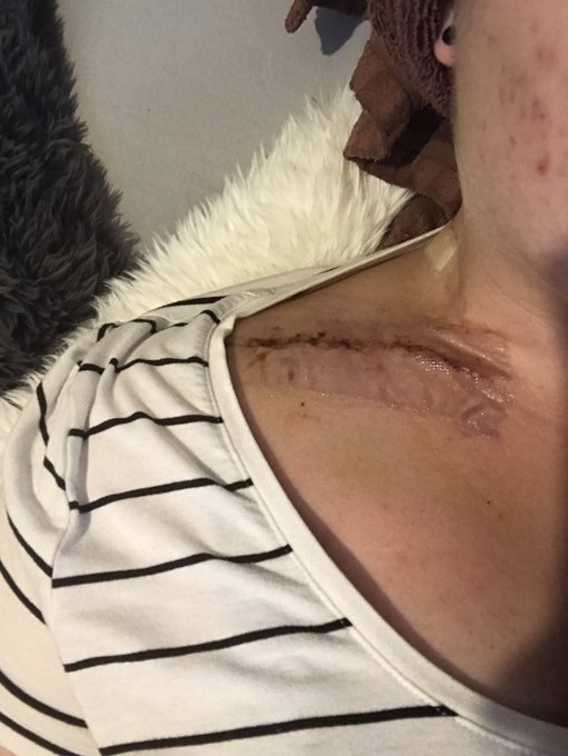 At least I&rsquo;ll have a cool scar &hellip;right? 😳😂😂 https://t.co/7hANcQ0MWt<a href="/tag/mvsales"class="tags"><span>#mvsales</span></a>