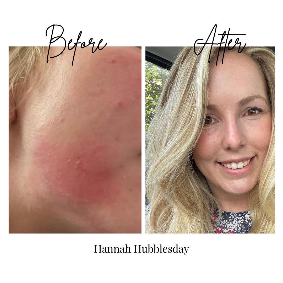 "..I had red flakey patches that even prescribed creams weren't shifting. Since using this magical cream my skin has been so much clearer and I feel much more confident because of it. I'd not hesitate to recommend this wonder cream to anyone! " Hannah Hubbleday
#skincareproducts