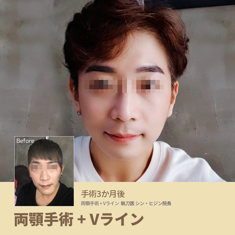 Eu口腔顎顔面外科 韓国no 1両顎 輪郭専門病院 男だって童顔になりたい 面長の ずれた顔から 短く優しい印象へと大 変 身 両顎手術 Vライン手術 輪郭手術 童顔 イケメン オルチャン 韓国整形 Eu口腔顎顔面外科 お問い合わせは