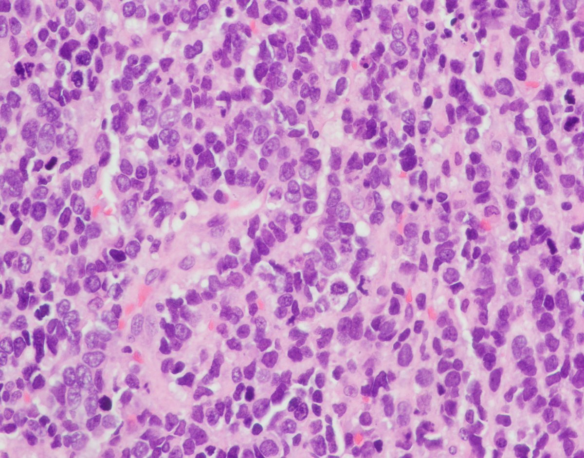 CaDxPath's tweet photo. You can subdivide lung small cell carcinoma into subtypes based on transcriptional regulators
Therapeutic significance still being investigated-but useful to know from diagnostic pathology point of view
Let me tell you about 'tuft cells' and why they're good to know about https://t.co/FFX1iV6udM