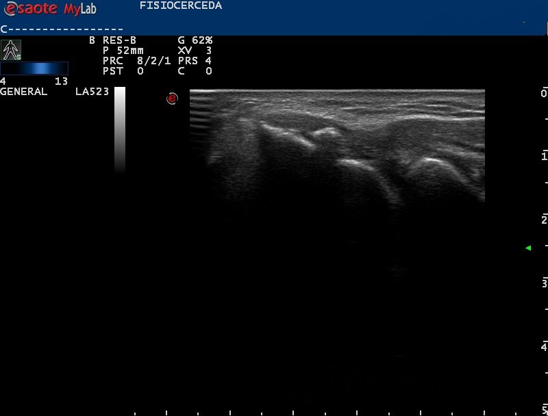 No todos los dolores de codo son producidos por degeneración o inflamación del tendón 😲.
.

Tras exploración ecográfica encontramos un artefacto hiperecoico con sombra acústica compatible con una calcificación y un tendón con ecoestructura normal.
.

#ecografia #fisiocerceda