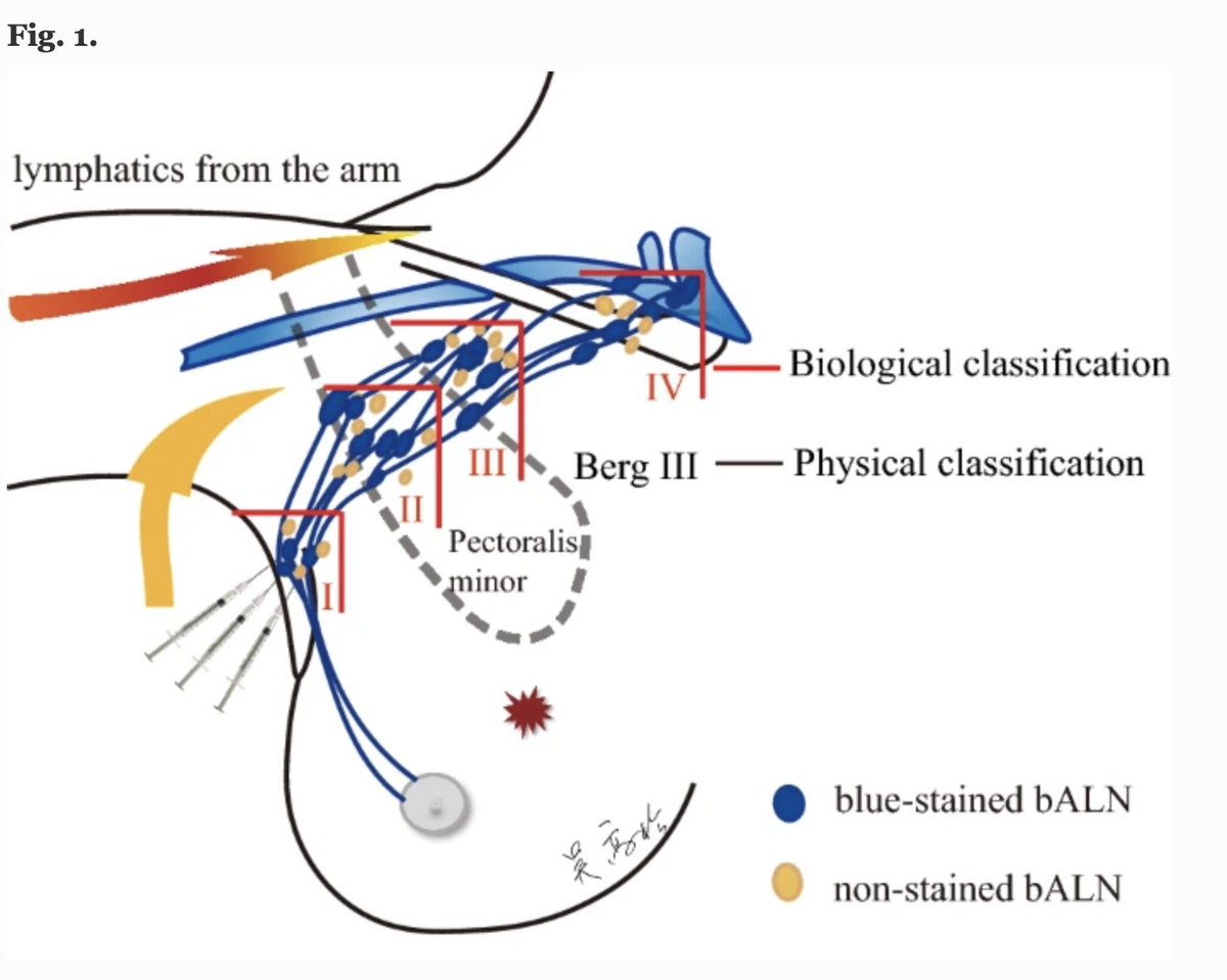 Annals of Surgical Oncology (@annsurgoncol) on Twitter photo AHEAD OF PRINT: Stepwise Limited #AxillaryLymphNodeDissection Based on Lymphatic Drainage from the Breast to Decrease #BreastCancer-RelatedLymphedema: A Randomized Controlled Trial. #breastcancer rdcu.be/cq2j6 <a href="/McMastersKelly/">Kelly McMasters, MD, PhD</a> <a href="/SocSurgOnc/">Society of Surgical Oncology</a> AHEAD OF PRINT: Stepwise Limited #AxillaryLymphNodeDissection Based on Lymphatic Drainage from the Breast to Decrease #BreastCancer-RelatedLymphedema: A Randomized Controlled Trial. #breastcancer rdcu.be/cq2j6 <a href="/McMastersKelly/">Kelly McMasters, MD, PhD</a> <a href="/SocSurgOnc/">Society of Surgical Oncology</a>