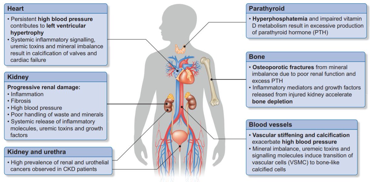 NDTsocial's tweet photo. 👉Midkine and chronic kidney disease-associated multisystem organ dysfunctions 
FREE access:📖https://t.co/k9beDt057U🔓
📸Multi-organ dysfunction associated with CKD
#biomarker #CKD #Midkine https://t.co/HIGsldFqPj
