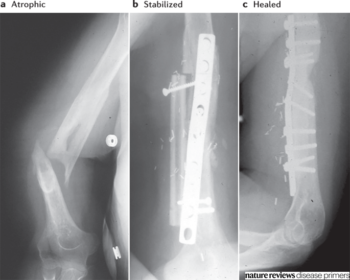 DiseasePrimers's tweet photo. This figure shows the treatment of humerus #atrophic #nonunion involving restabilization with a plate and a vascularized fibula graft.

https://t.co/L9nEj9tJYU https://t.co/uJDn4a9Nv8
