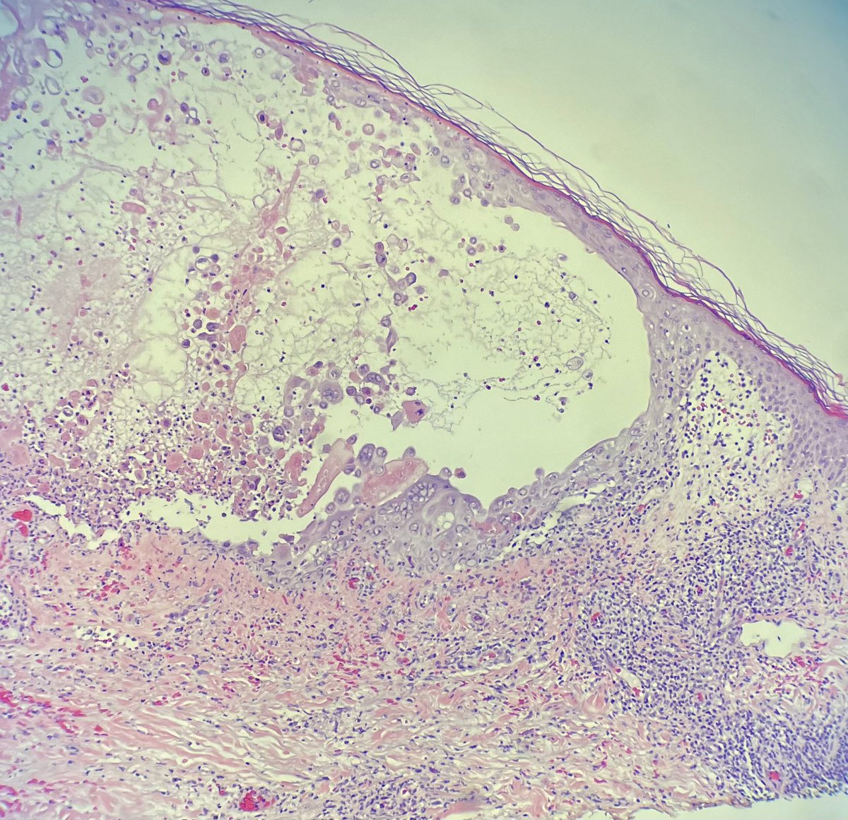 RomyCPerez's tweet photo. Today was a good day! This blistered lesion has some not-so-hidden “M” features that help with the diagnosis. Even skin is not free from the herp! 1/2 https://t.co/zCjXiwzFbx