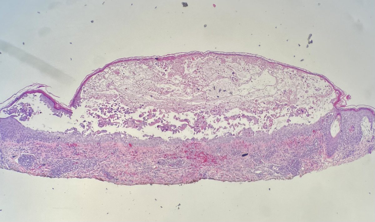 RomyCPerez's tweet photo. Today was a good day! This blistered lesion has some not-so-hidden “M” features that help with the diagnosis. Even skin is not free from the herp! 1/2 https://t.co/zCjXiwzFbx