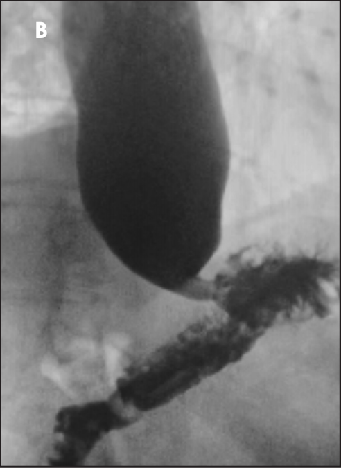 Applied_Rad's tweet image. The formulation of Barium Sulfate products determines their appropriate clinical utility which impacts patient management. Learn more in this CE/CRA program &amp;gt; bit.ly/3iukO2l #Fluoroscopy #Speechlanguagepathologists #AbdominalRadiologists #AbdRads #braccoimaging