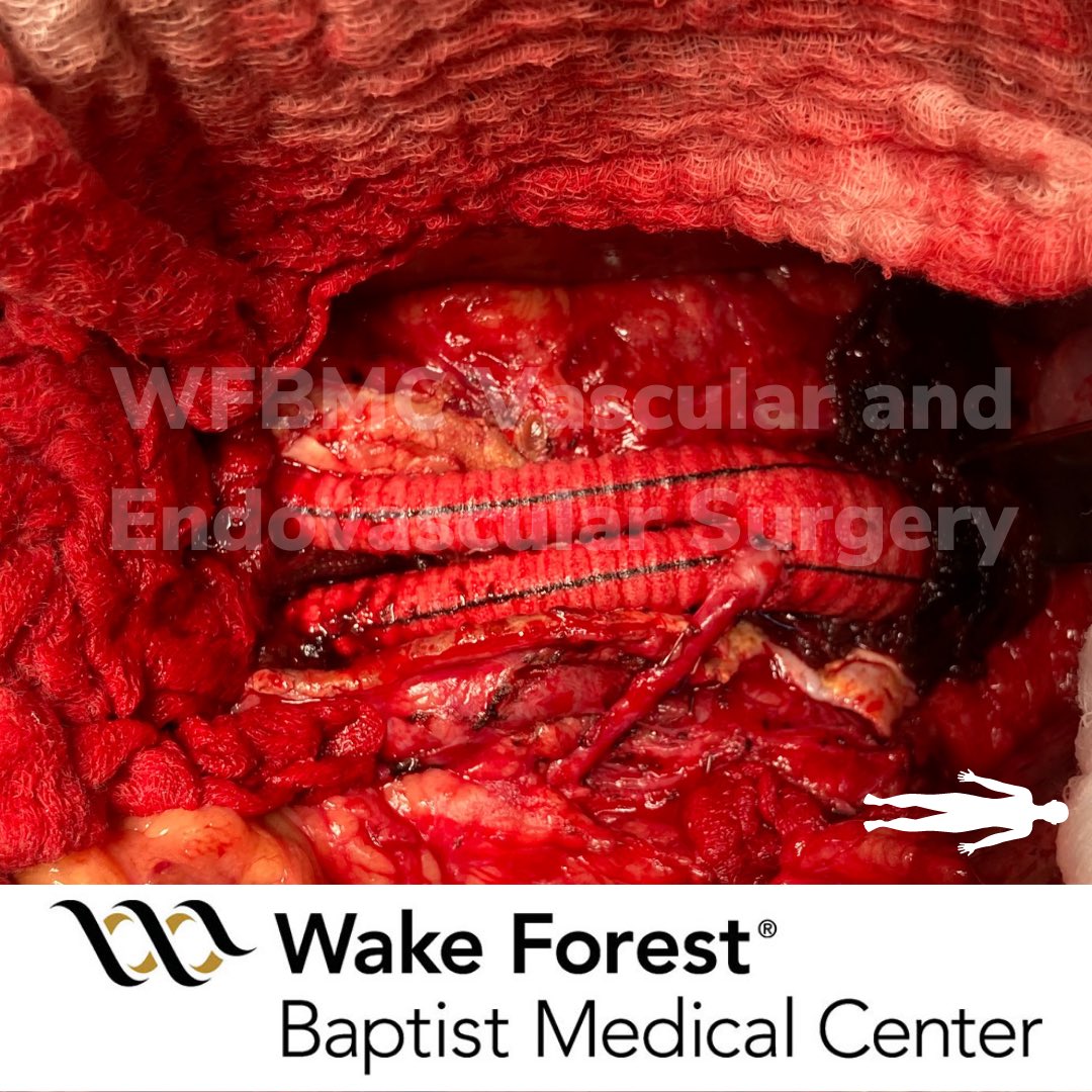 Wake Forest University Vascular Surgery tweet media