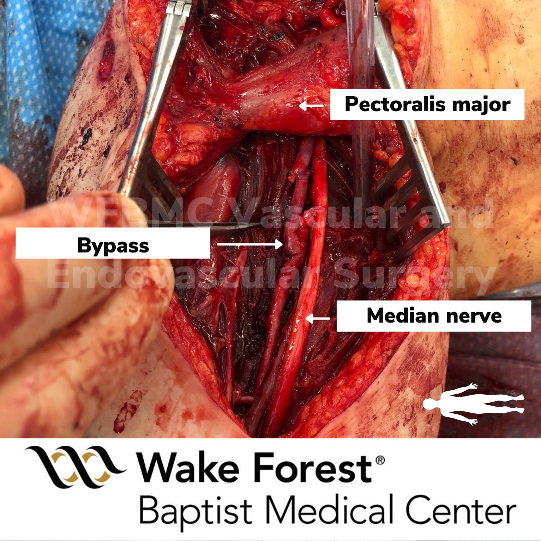 Wake Forest University Vascular Surgery tweet media