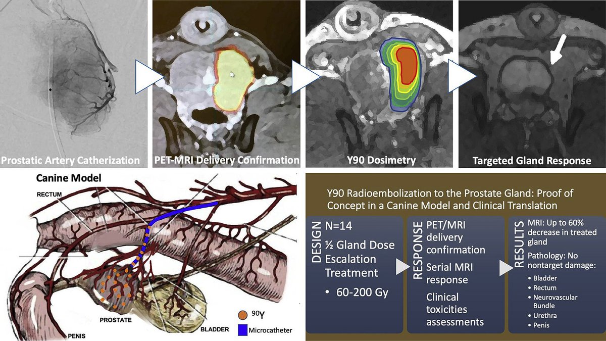 Yttrium-90 Radioembolization to the Prostate Gland: Proof of Concept in a Canine Model and Clinical Translation. <a href="/SamMouli/">Sam Mouli</a> <a href="/RaiterSimone/">Simone Raiter, MD</a> <a href="/andrew_c_gordon/">Andrew C Gordon</a> <a href="/MonicaMatsumoto/">Monica Matsumoto</a> <a href="/DrCliffWeiss/">Clifford R Weiss, MD</a> <a href="/dhkim0405/">Dong-Hyun Kim (BIGMed Lab @Northwestern Univ.)</a> <a href="/riadsalemIR/">Riad Salem</a>  bit.ly/2Vx5yIW #irad
