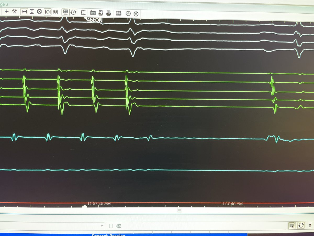 First time feeling the satisfaction of a successful CTI line!