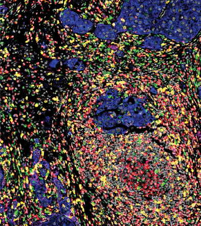 harlee_luv008's tweet photo. Multiplex IHC on a single slide to profile the bladder tumor microenvironment @MiriamMerad @SinaiImmunol @BhardwajLab @AmirHorowitz @DrJohnSfakianos #SachaGnjatic #GurayAkturk @TischCancer 
https://t.co/oDixEQ3KUw https://t.co/pn2gV0lxOa
