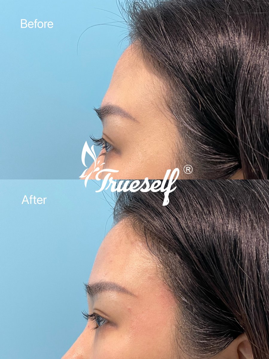 Trueself PLLA Dermal Filler used for forehead. #trueselfplla #plladermalfiller #pllafiller #trueselffacial #facelifting #plladermal #sculptrafacial #antiwrinkle #dermalfiller #fillerinjection #skincare #collagenregeneration #PLLAPowder #PolyLLacticAcid #plla #pcl #pllapowder