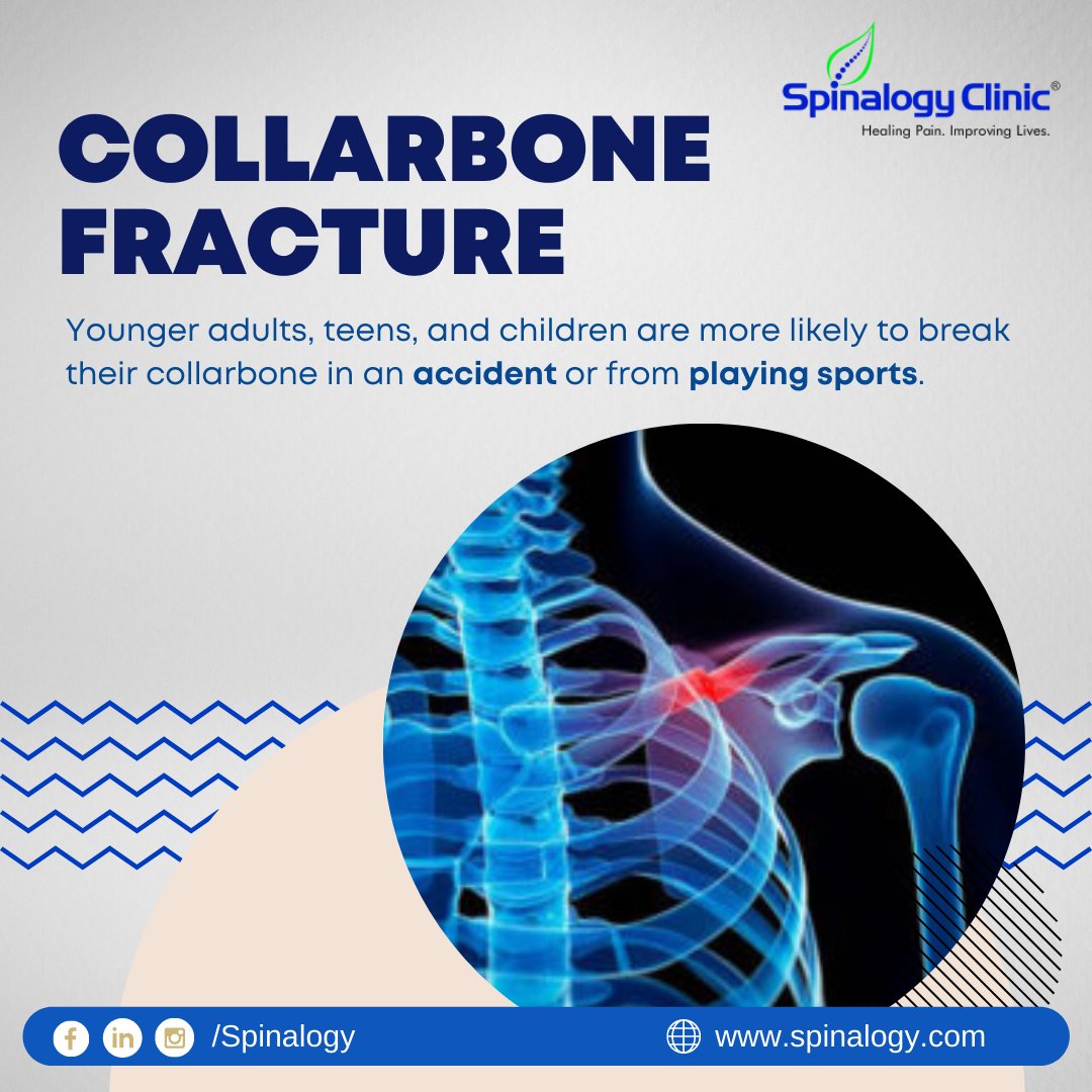 Spinalogy Clinic on Twitter "𝐂𝐨𝐥𝐥𝐚𝐫𝐛𝐨𝐧𝐞 𝐅𝐫𝐚𝐜𝐭𝐮𝐫𝐞 Younger adults, teens