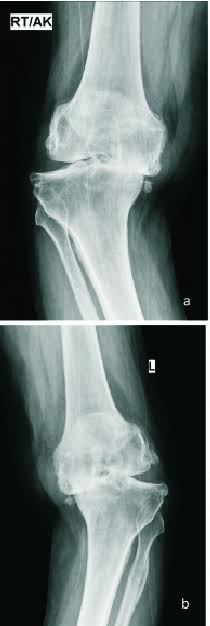 Uda pada pernah denger kan tentang penyakit OSTEOARTHRITIS/pengapuran sendi?

Kondisi penyakit yg mau ga mau,suka ga suka,kita smua nantinya akan kena

Gejalanya mulai dari lutut sakit,kaku,bhkan yg parah sampe ga bisa jalan
Dan kasusnya semakin byk aja di usia muda

- A THREAD -