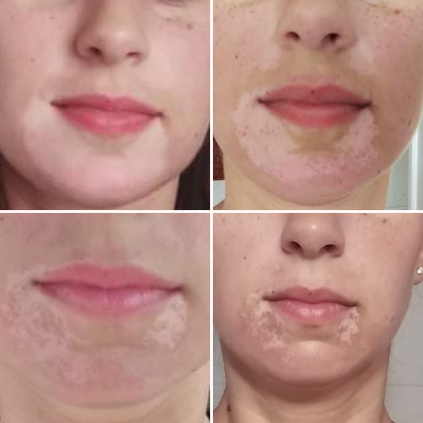 matteobordignon's tweet photo. #Repigment12 - antioxidants - sun - 2 months of treatment! And full speed ahead!

#vitiligo #vitiligine #bellaaurora @bellaaurora_com #matteobordignon https://t.co/8dkyRqSusT