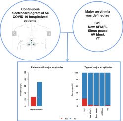 Copenhagen Cardiovascular Research Center (@copcard) on Twitter photo 📣 The ACOVID SDY📣 by @bochrajamal et al
A <a href="/cortrium/">Cortrium | Revolutionising ECG Recordings</a> 3+ device was placed upon day of admission in 54 ptts w/ #Covid_19
Findings
1️⃣28% developed SVT (4% #Afli #AFLA)
2️⃣Critical arrhythmias were rare.
📝bit.ly/3ClvIPF
<a href="/hrs_journal/">HeartRhythm</a> #OpenAccess #cardiotwitter <a href="/drjohnm/">John Mandrola, MD</a> 📣 The ACOVID SDY📣 by @bochrajamal et al
A <a href="/cortrium/">Cortrium | Revolutionising ECG Recordings</a> 3+ device was placed upon day of admission in 54 ptts w/ #Covid_19
Findings
1️⃣28% developed SVT (4% #Afli #AFLA)
2️⃣Critical arrhythmias were rare.
📝bit.ly/3ClvIPF
<a href="/hrs_journal/">HeartRhythm</a> #OpenAccess #cardiotwitter <a href="/drjohnm/">John Mandrola, MD</a>