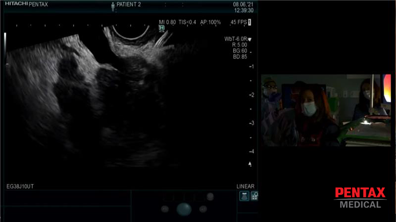 PENTAXAmericas's tweet photo. Thank you Dr. Michel Kahaleh, Dr. Marina Kim and Dr. Jessica Widmer for sharing a successful #FNB of a pancreatic head mass using the new PENTAX #ultrasound gastroscopes at @magicendoscopy!
#MAGIC2021 #gastroenterology #eus #gastroenterologist #endoscopy #PENTAXMedicalTripleAim https://t.co/mRSCzu2GuY