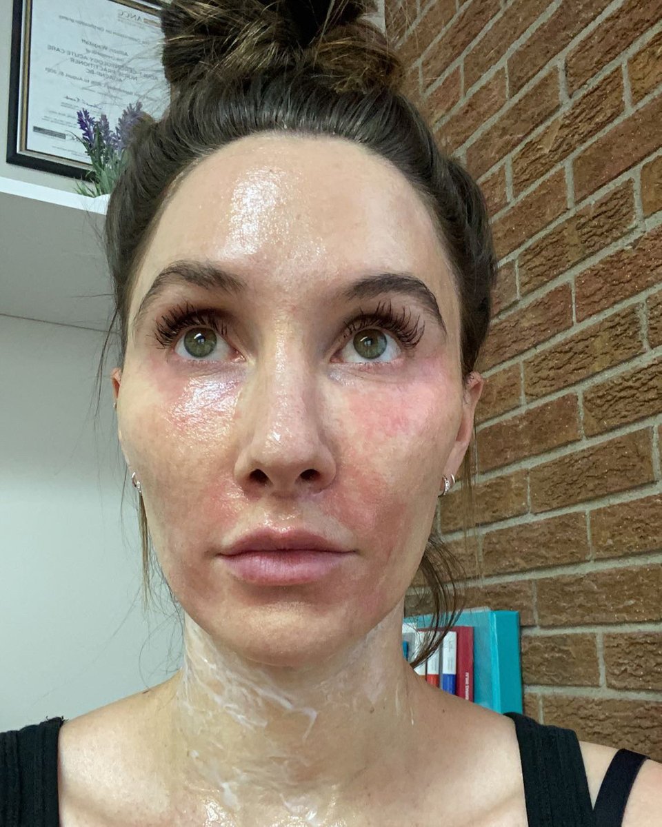 What is happening here? I have on a topical lidocaine/prilocaine numbing cream before a RF microneedling treatment.

The medication blanches the skin, or created areas of whiteness/lightness. That’s why my face looks all blotchy.

It can be great for some injections because it