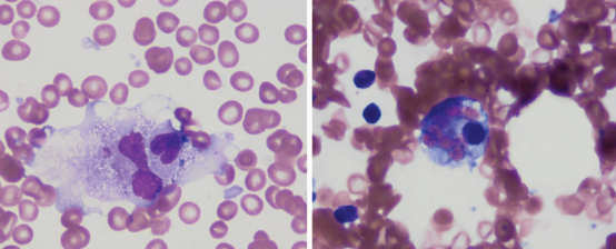 Pathologists's tweet photo. Hemophagocytic Lymphohistiocytosis; read this @ArchivesPath Early Online Release from @loyolapathology's Tanya Sajan Ponnatt, MD, @KMirza &amp; @cullen_lilley: https://t.co/lnaaZBKJrF. #pathologists https://t.co/oagl45B8al